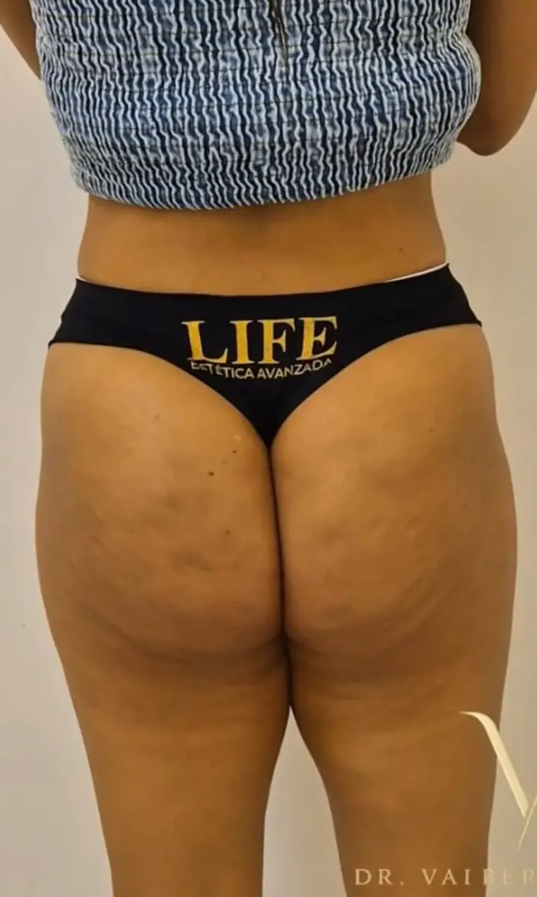 Antes — Tratamiento de celulitis