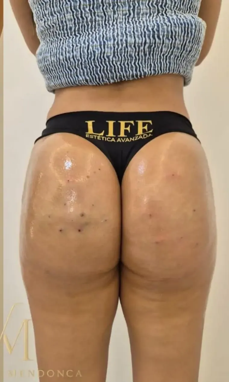 Después — Tratamiento de celulitis