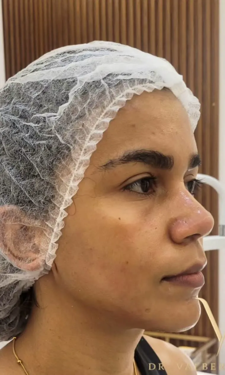 Antes — Armonización facial femenina