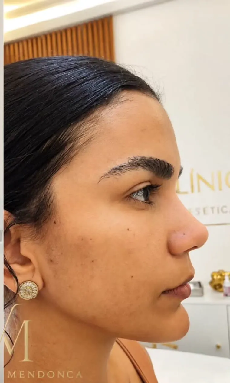 Después — Armonización facial femenina