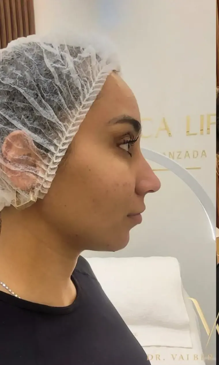 Antes — Tratamiento de ojeras