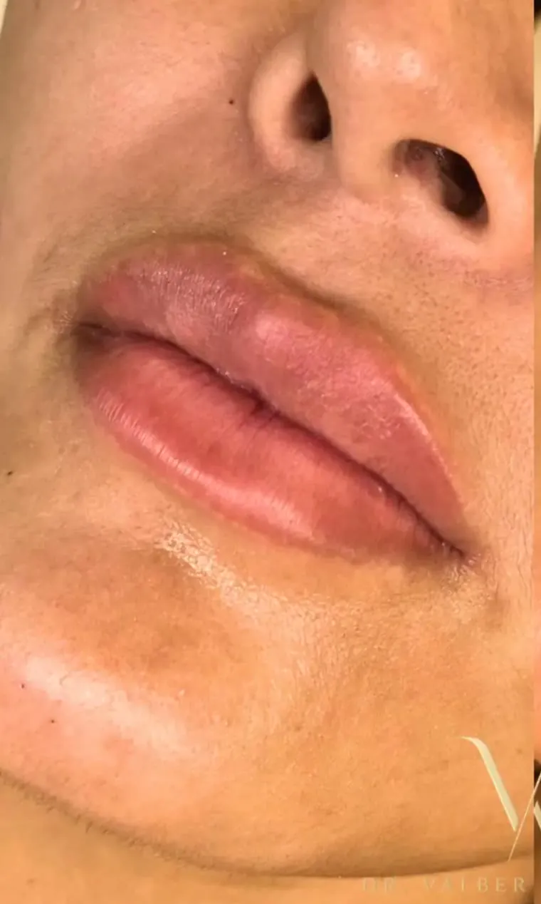 Antes — Relleno de labios