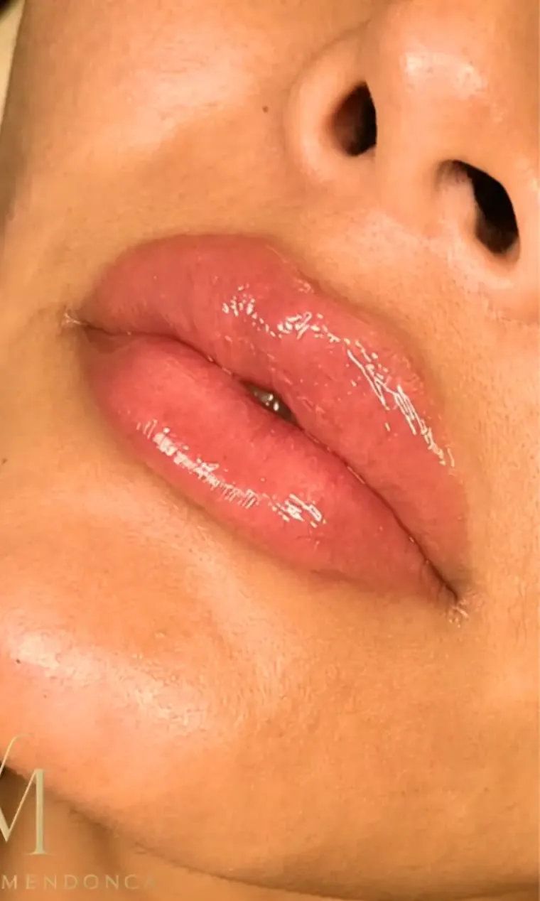 Después — Relleno de labios