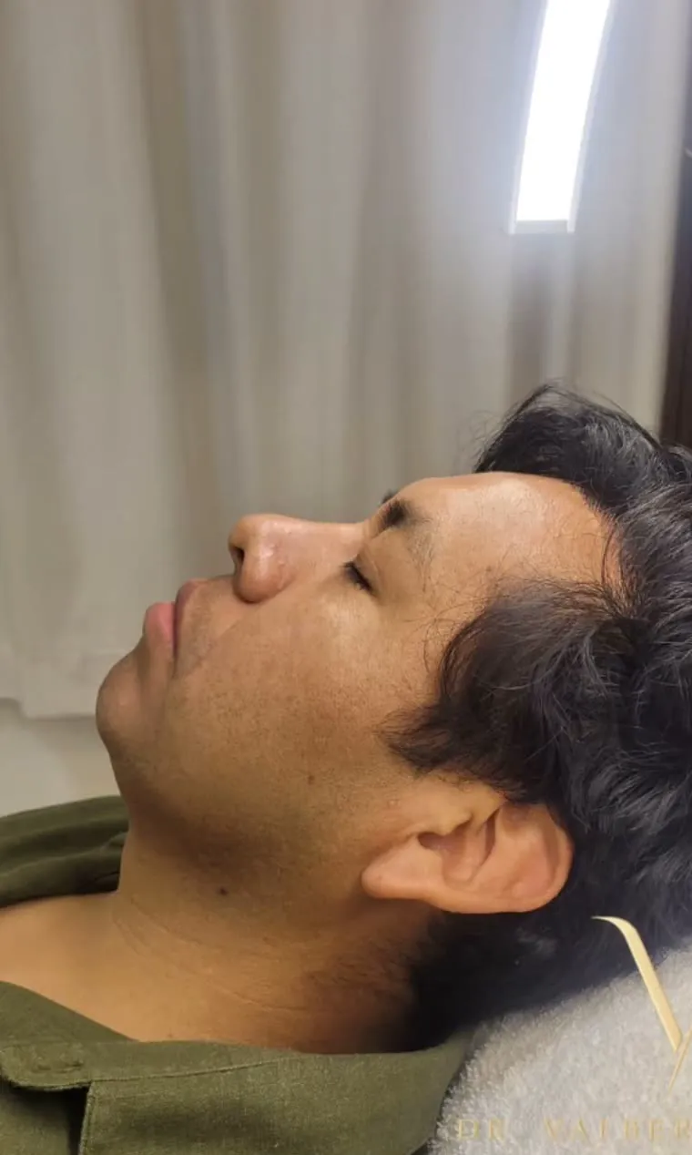 Antes — Armonización facial masculina