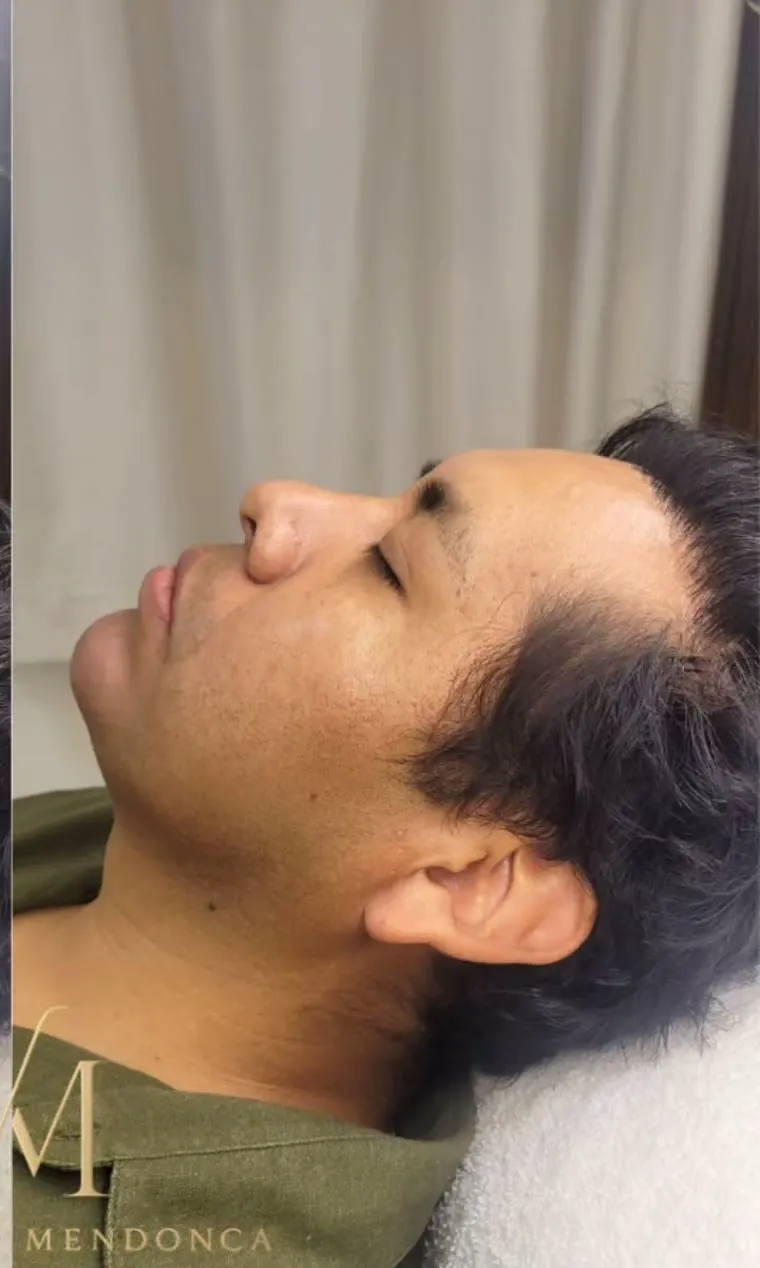 Después — Armonización facial masculina