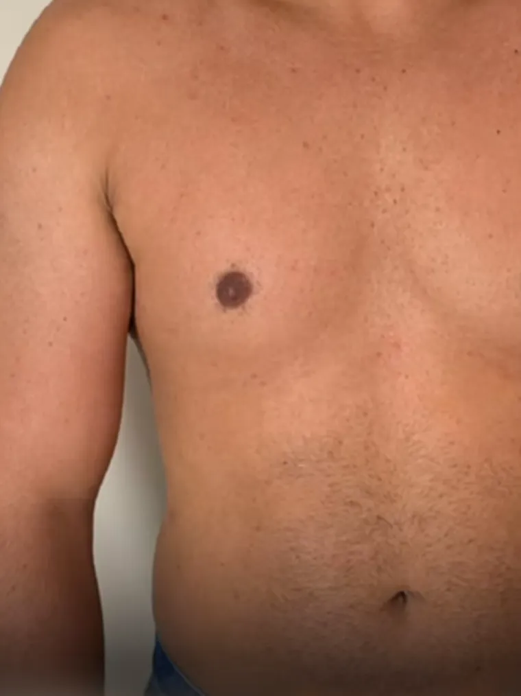 Antes — Marcación de pectorales