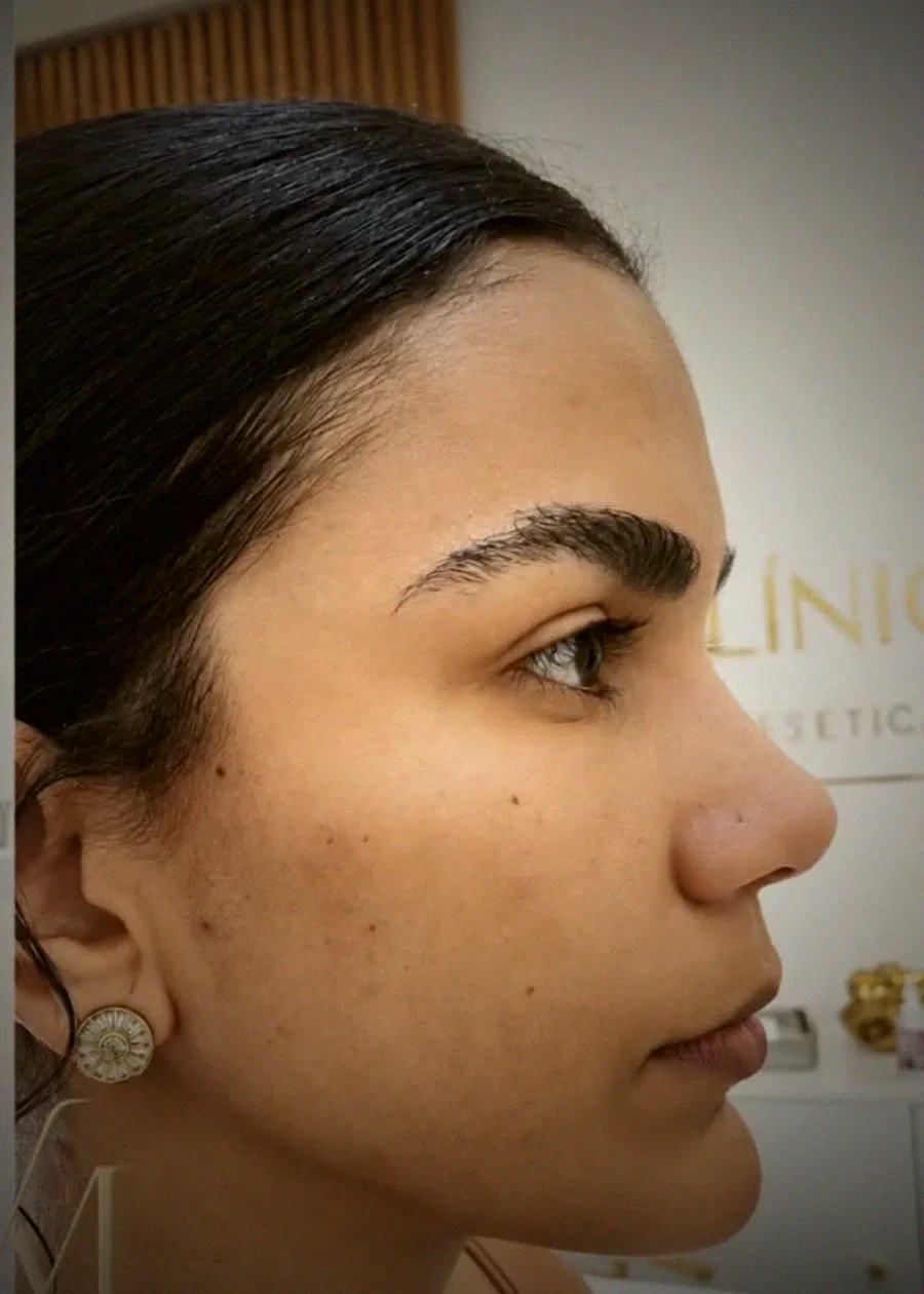 Armonización facial femenina en Santa Cruz