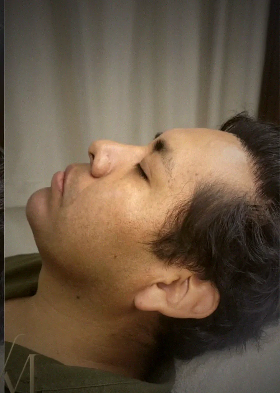 Armonización facial masculina en Santa Cruz