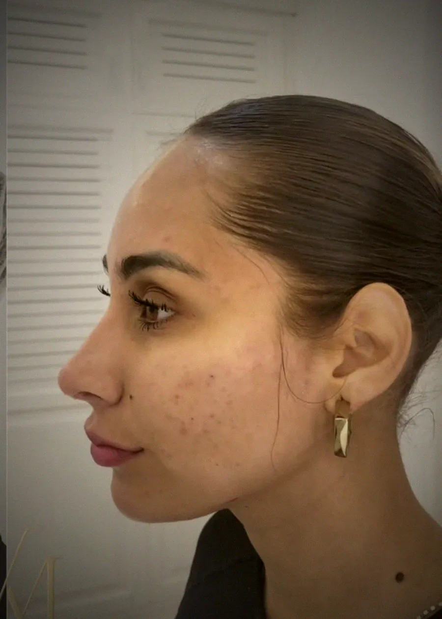 Perfilado mandibular en Santa Cruz — Dr. Valber Mendonça