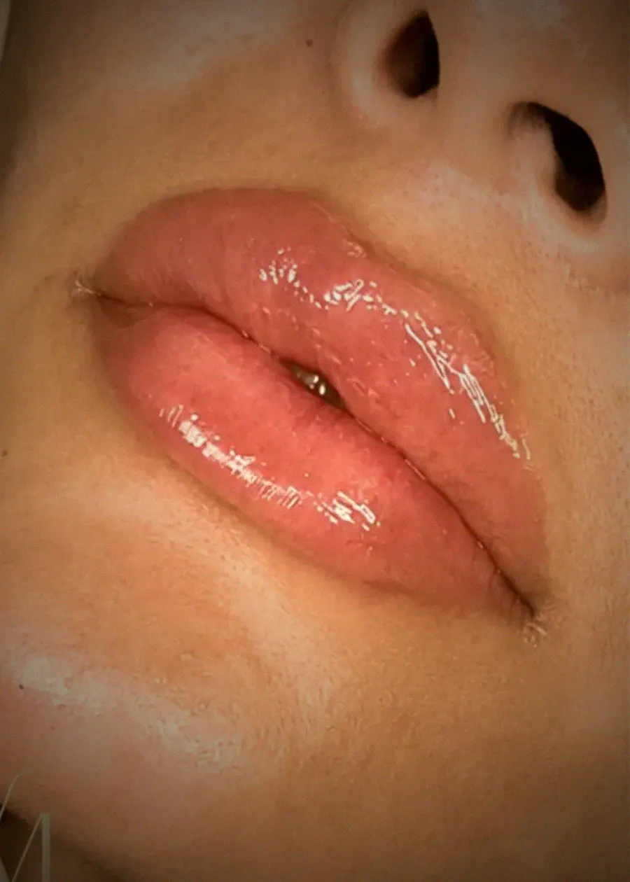Relleno de labios en Santa Cruz